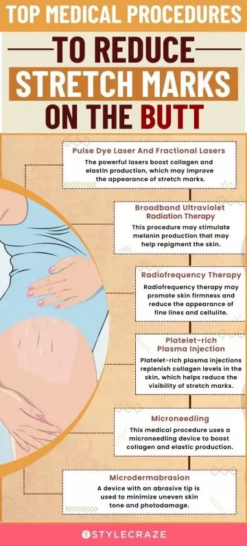 top medical procedures to reduce stretch mark (infographic)
