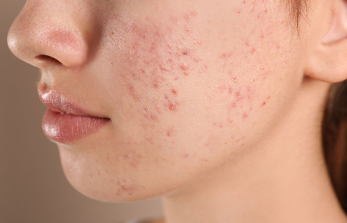 Acne May Be Exacerbated By Milk