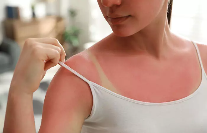 Sunburns