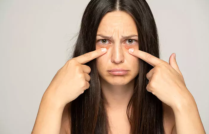 Treat Your Under Eye Circles