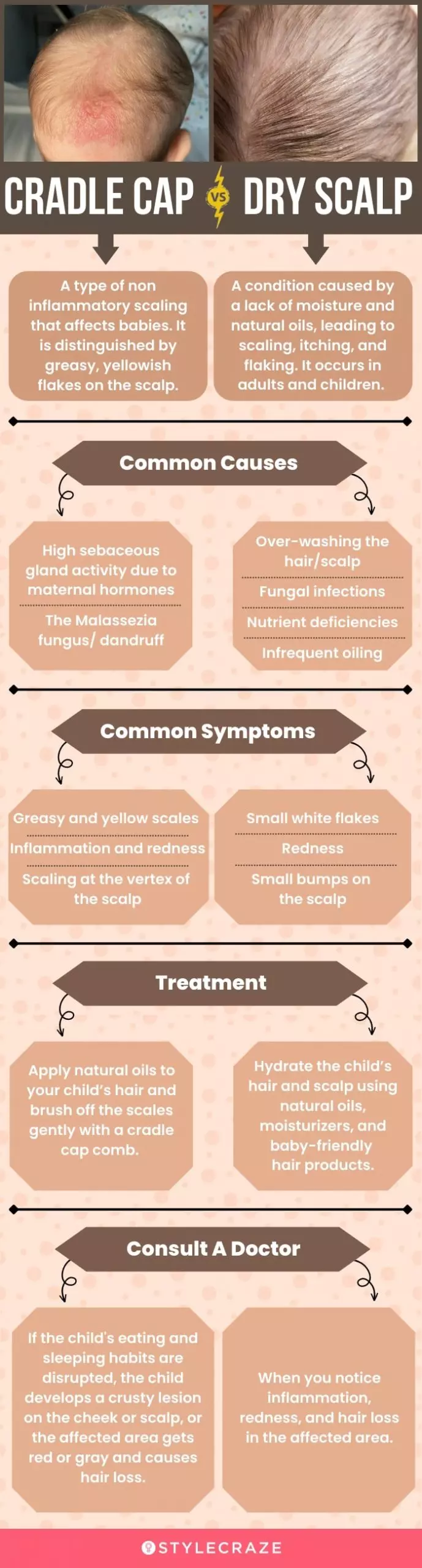 cradle cap vs. dry scalp (infographic)