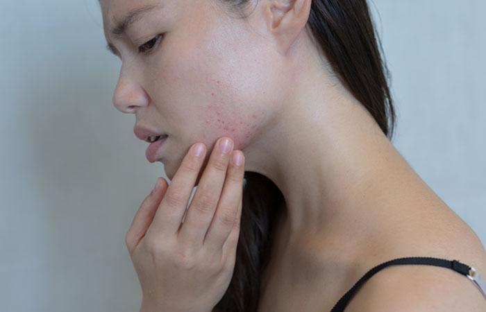 It May Cause Breakouts
