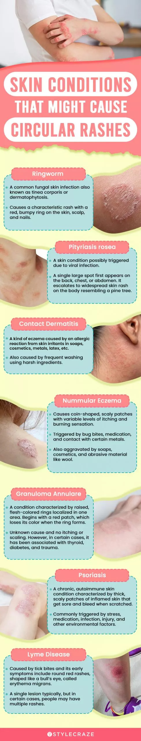 skin conditions that might cause circular rashes (infographic)