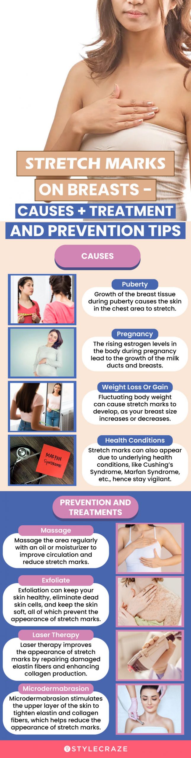 causes of stretch marks on breasts, prevention, and treatment (infographic)