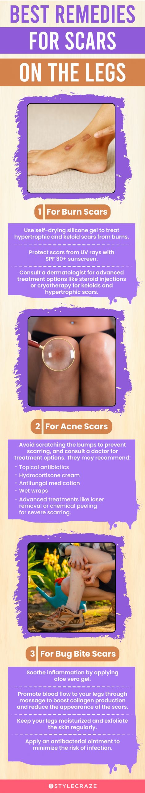 best remedies for leg scars (infographic)