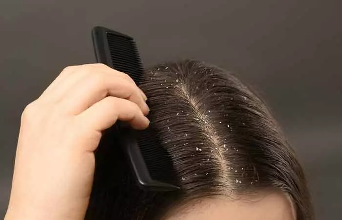 How-To-Rid-Yourself-Of-Dandruff