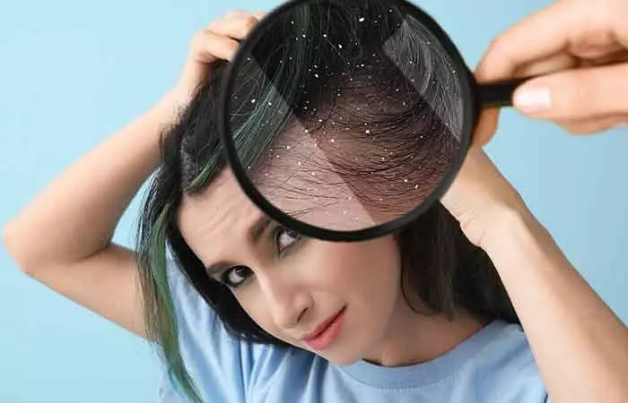 What-Makes-Dandruff-Appear-On-Your-Scalp