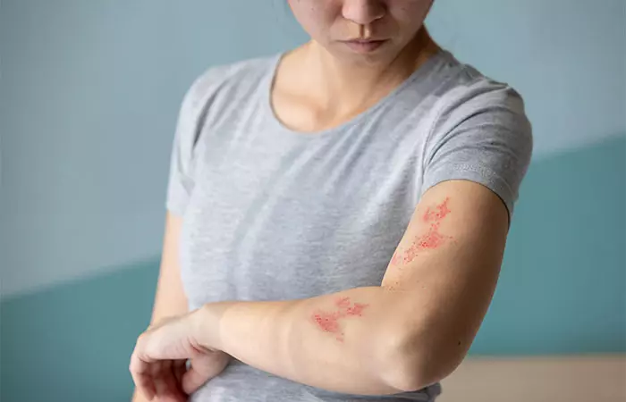 What is Chicken Skin?