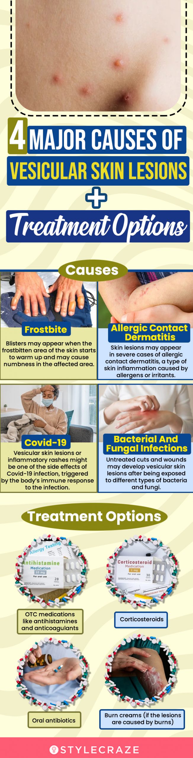 4 major causes of vesicular skin lesions + treatment options (infographic)