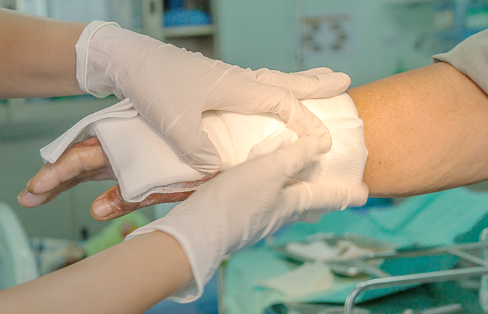 Common Mistakes To Avoid During Minor Burns