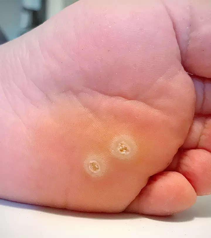 How To Get Rid Of Warts On Your Feet