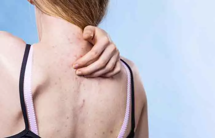 It-May-Lead-To-Body-Acne