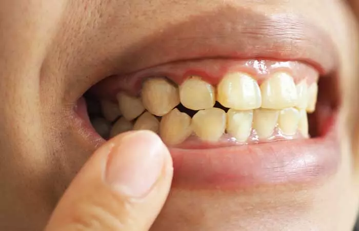 Poor Condition Of Your Teeth