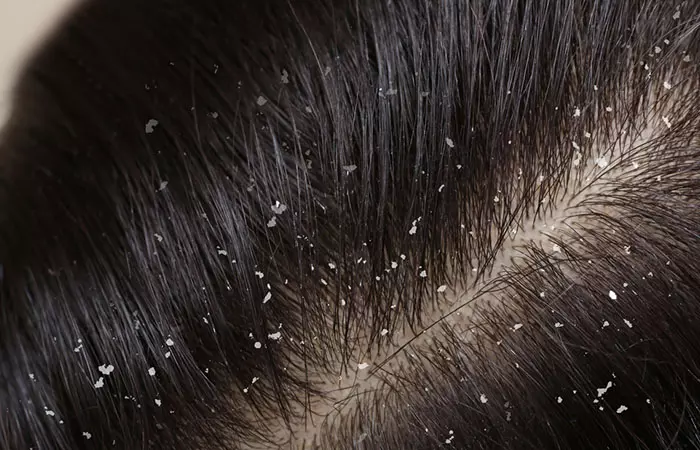 Itchy And Flaky Scalp