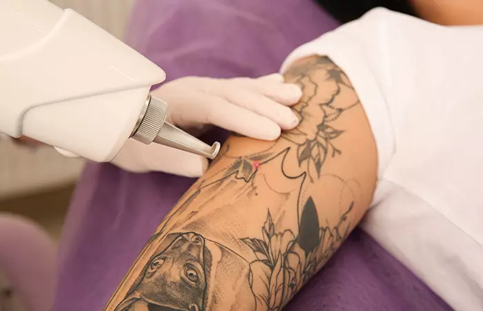 A tattoo artist holds the upper arm of a client who is undergoing a laser treatment session to help fix a blowout.