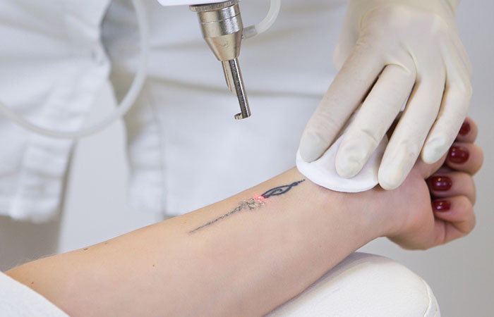 A woman getting her tattoo removed through laser therapy.