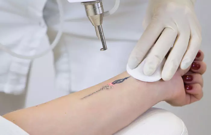A woman getting her tattoo removed through laser therapy.