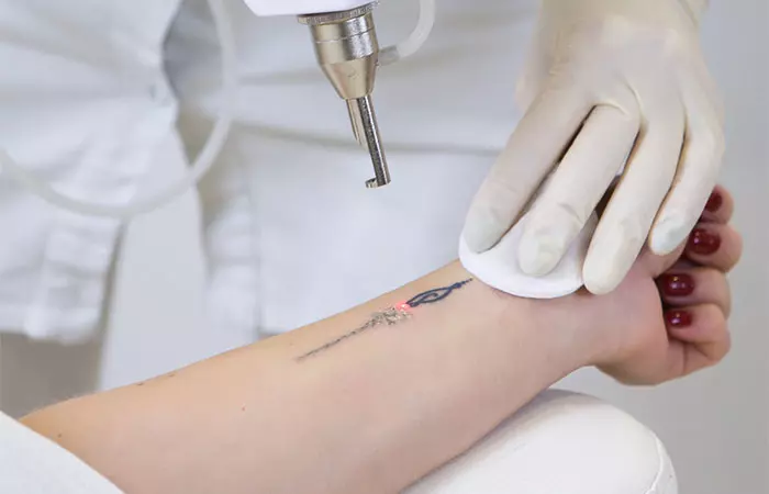 Close-up of laser tattoo removal from a woman’s hand