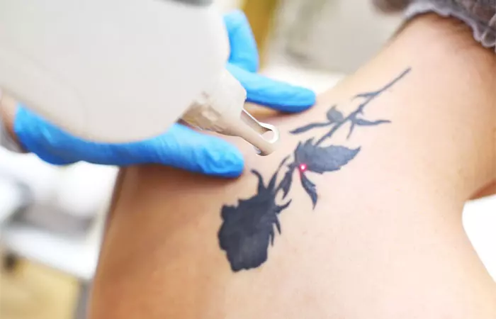 Cosmetologist removing the tattoo using a neodymium laser