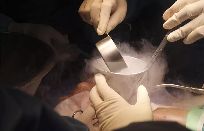 Cryosurgery for fading a tattoo