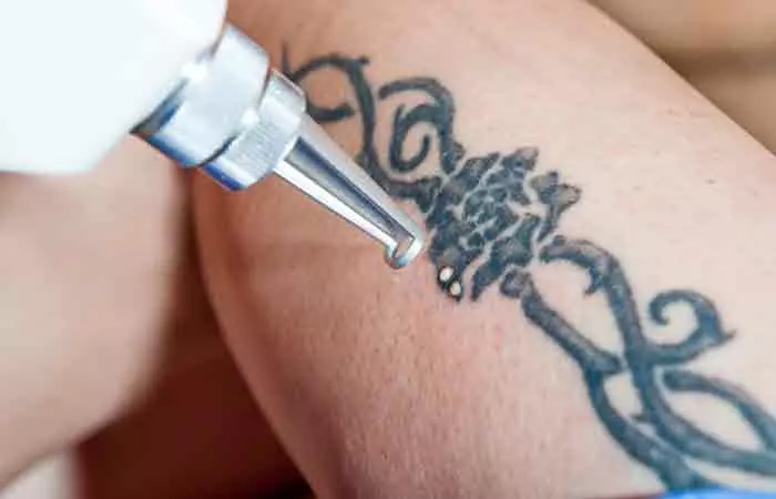 Removing a tattoo with lasers
