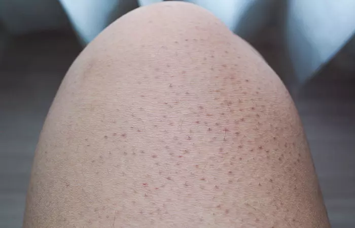 Keratosis Pilaris
