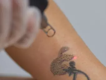 Laser Tattoo Removal: How Does It Work And Its Side Effects