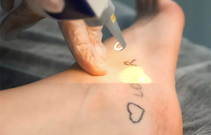 Laser surgery for fading a tattoo