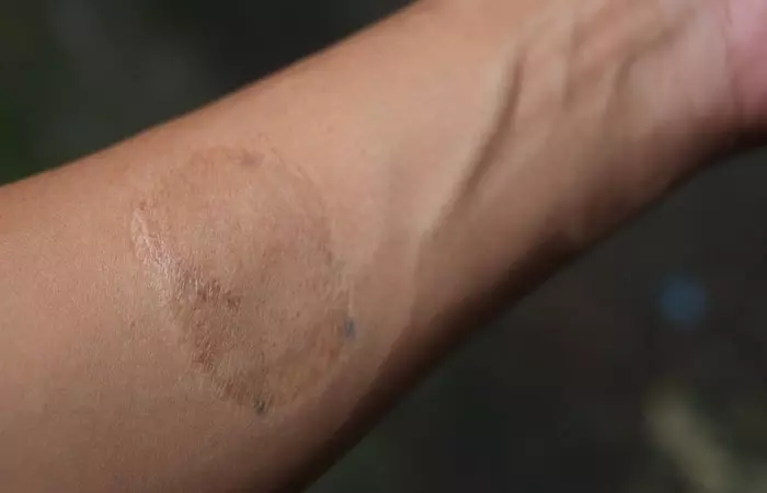 scar after tattoo removal