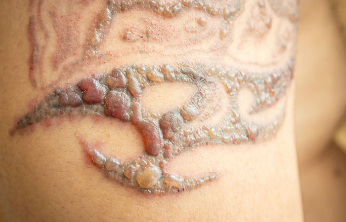 Can a tattoo artist camouflage an ugly mole or birth mark? - Quora