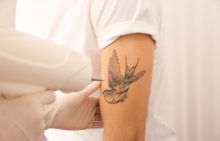 Painless Tattoo Removal: Does It Exist | Tattoo Removal Institute