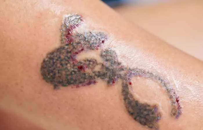 Tattooed area infected due to improper aftercare.