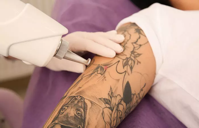 Laser tattoo removal is the most effective way to fade tattoo ink.