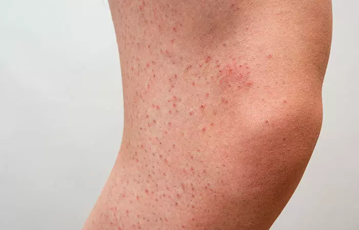 What Causes Strawberry Legs