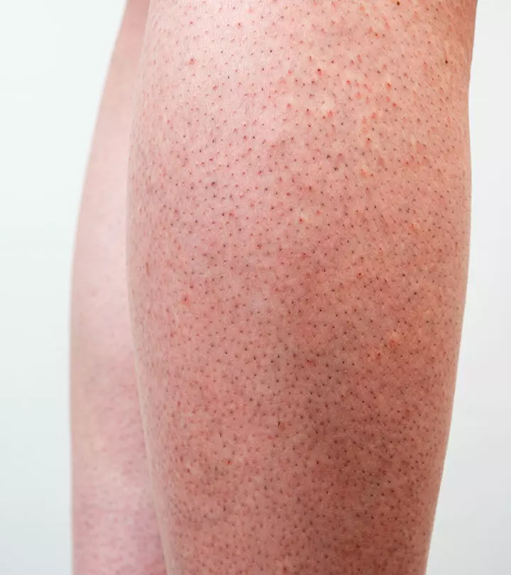 Strawberry Legs: Why They Occur And How To Get Rid Of Them Naturally