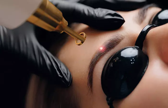 A cosmetic tattoo expert doing a laser removal of an eyebrow tattoo