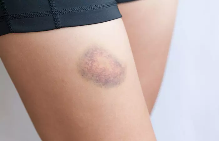 A woman with bruised leg