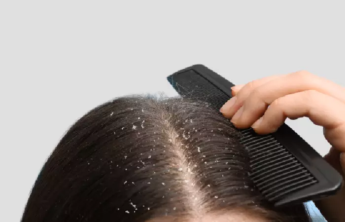 Combat Dandruff The Right Way
