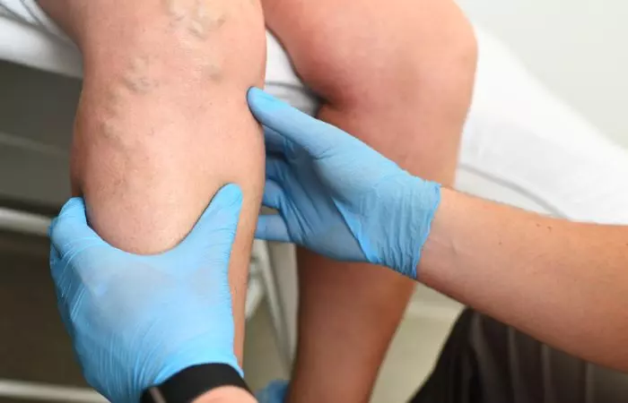 Doctor examining a patient’s varicose veins