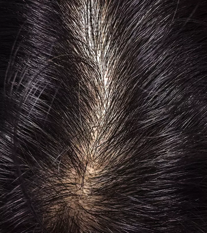 How To Manage Oily Scalp Problems?