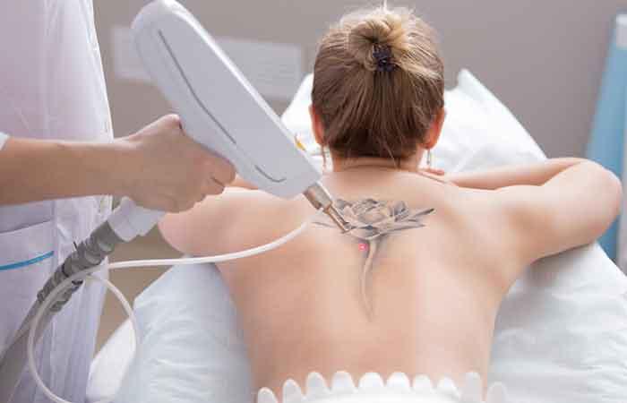 A woman getting a tattoo removed using laser treatment