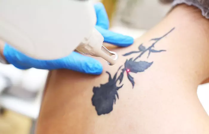 tattoo being removed with laser