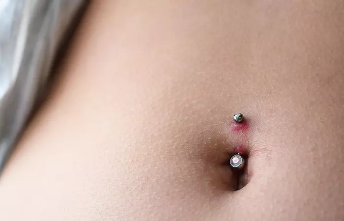 A belly button piercing in the healing stage