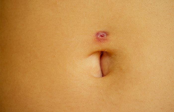 How long does it take for hot sale an infected belly button piercing to heal