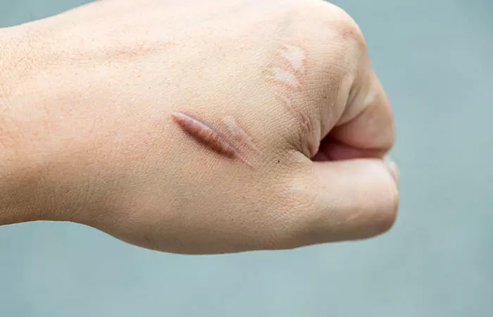 A keloid scar on a woman’s hand