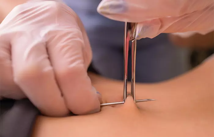 A person undergoing surface piercing procedure