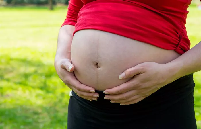 A pregnant woman with removed belly button piercing to prevent stretching.