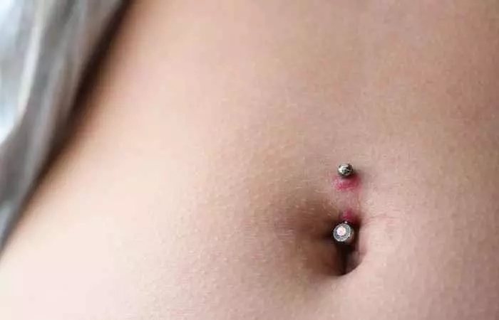 A woman developing a keloid on her belly piercing