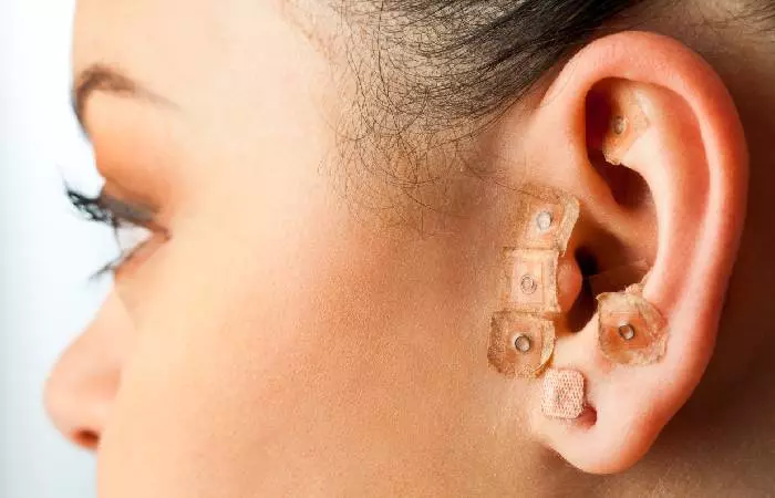 A woman who has undergone auriculotherapy, or ear acupuncture