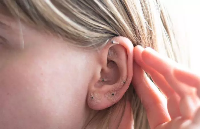 A woman who has undergone ear acupuncture